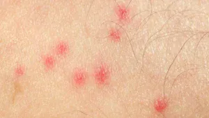Why Do Mosquito Bites Itch More at Night