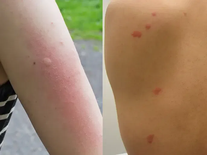 Mosquito Bites vs Bed Bug Bites
