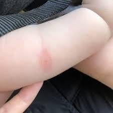 bedbugbitesonbabytreatment ezgif.com gif to jpg converter