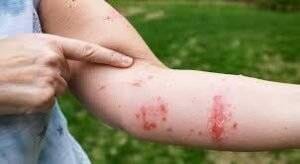 Does Rubbing Alcohol Help Poison Ivy