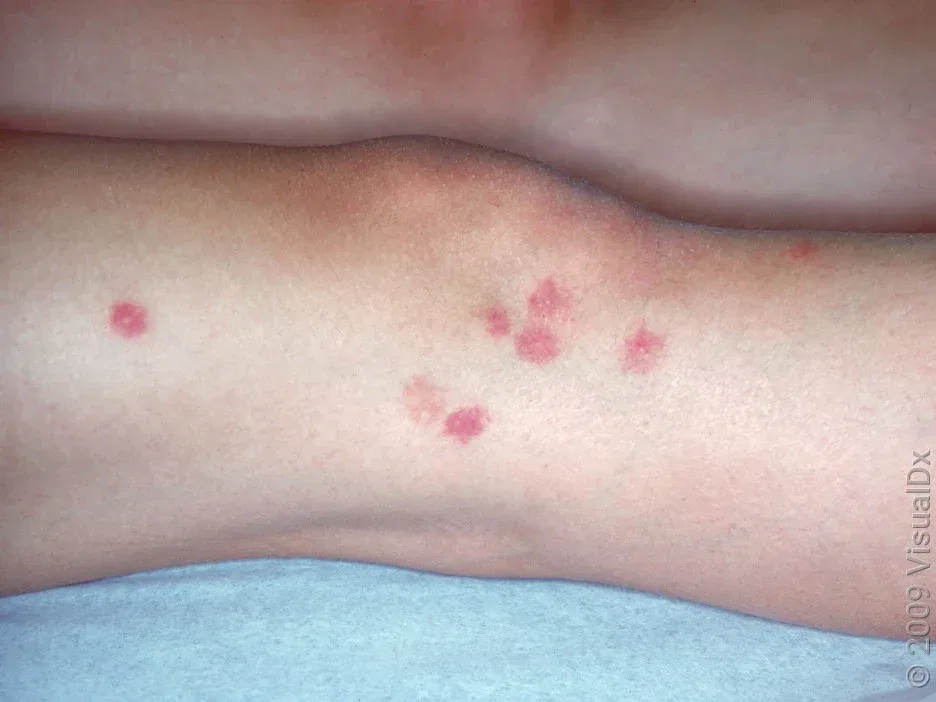 When to Go to the ER for an Insect Bite