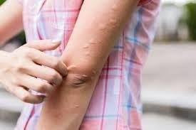 Hives vs Mosquito Bites