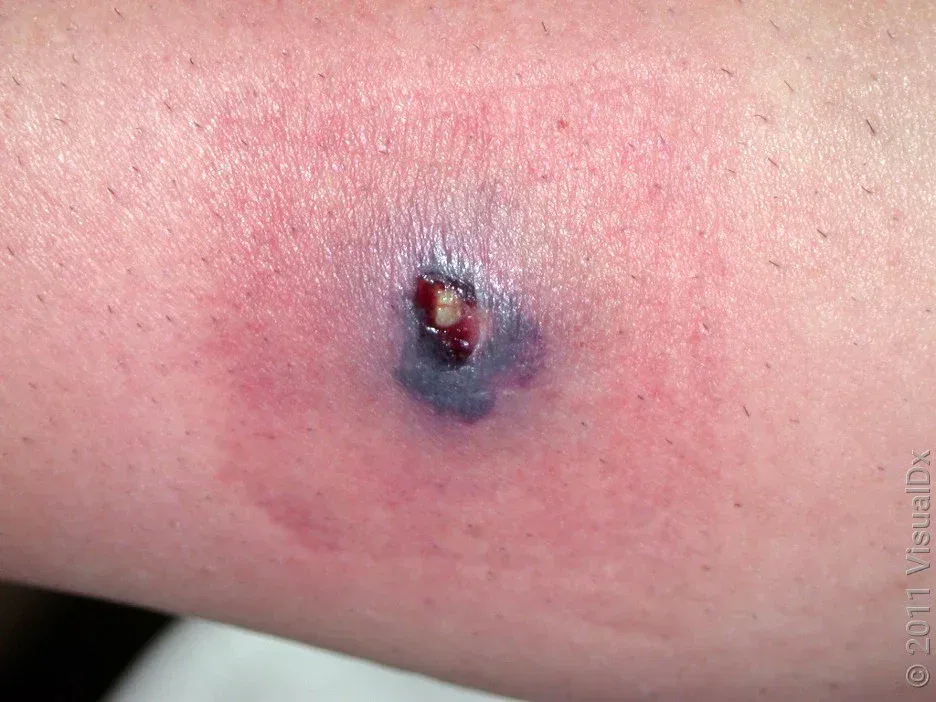 how to identify a spider bite on your skin