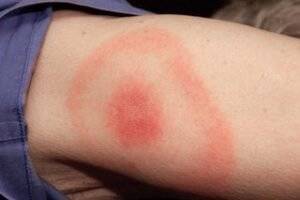 How to Safely Draw Out Infection from a Bug Bite