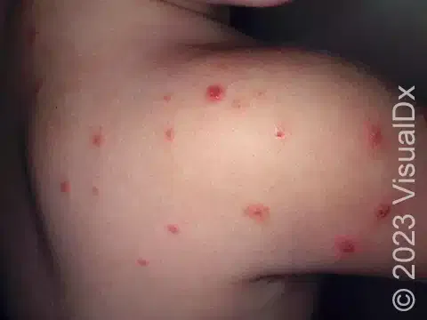 How to Treat Flea Bites on Kids