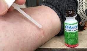 How to Get Rid of Chigger Bites Fast