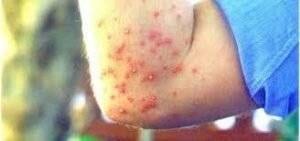 Pustules from Fire Ant Bites