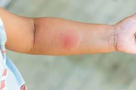 How to Tell If a Spider Bite Is Poisonous