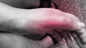 Lymphangitis from a Bug Bite