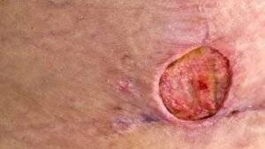 Staph vs. MRSA from a Bug Bite