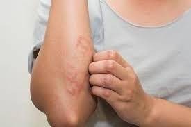 Eczema Flare Up vs Mosquito Bites
