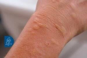 Asian Tiger Mosquito Disease Risks