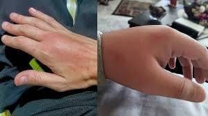 Swollen Hands After Multiple Mosquito Bites