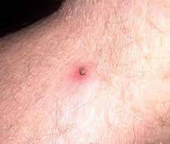 Symptoms of Tick-Borne Illness