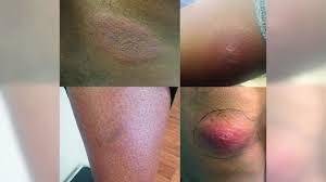 Lone Star Tick Bite Symptoms & Rash
