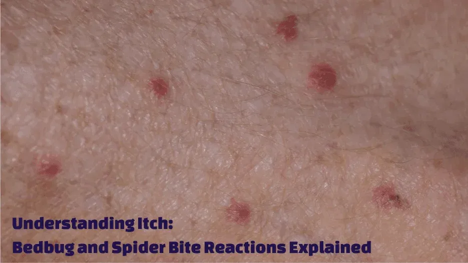 Bedbug and Spider Bite Reactions Explained