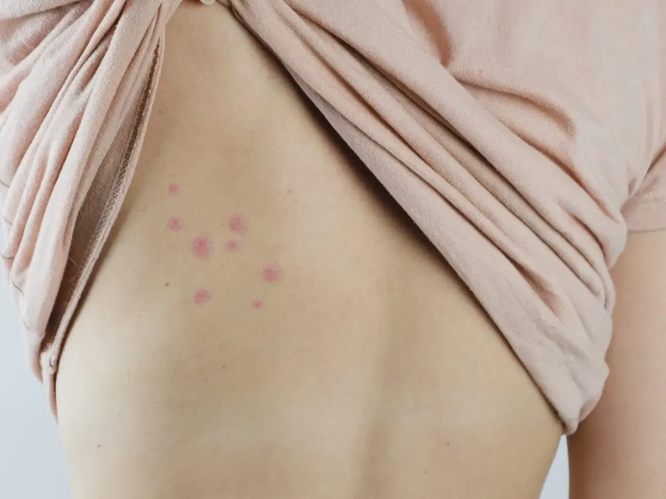 Spider Bite vs Bed Bug Bite: How to Tell the Difference