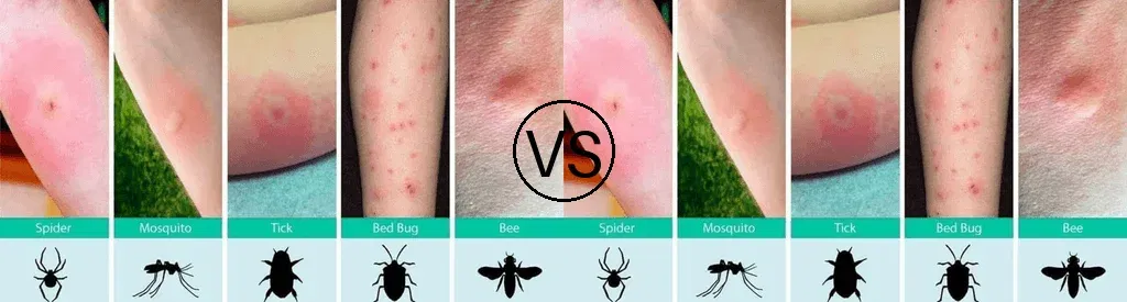 Flea Bites vs Bed Bug Bites