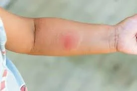 Allergic Reaction to Spider Bites