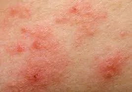 Allergic Reactions to Bites