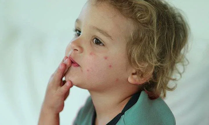 Bed Bug Bite Symptoms in Children