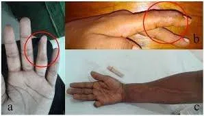 Body Detox After Venom Exposure