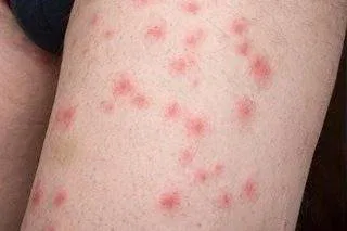 Do Bed Bug Bites Spread