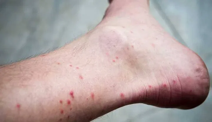 Flea Bite Relief Remedies