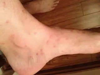 Flea Bite Scars Treatment
