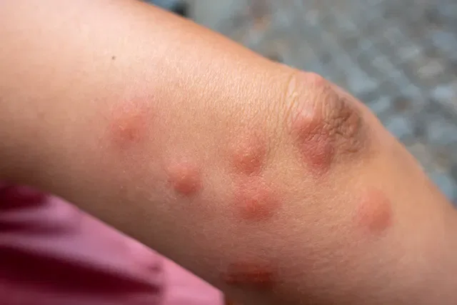 Flea Bites in Clusters
