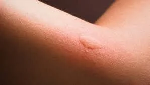 Healing Time for Mosquito Bites