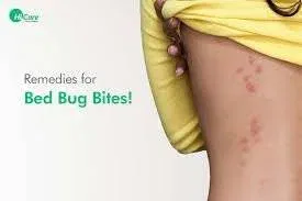 Home Remedies for Bed Bug Bites