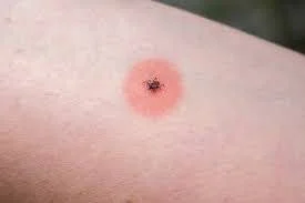 How to Know if Tick is Infected