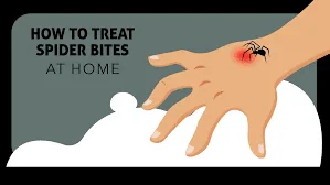 How to Treat a Spider Bite