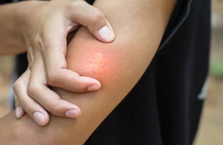 Inflammation After Sting Treatment