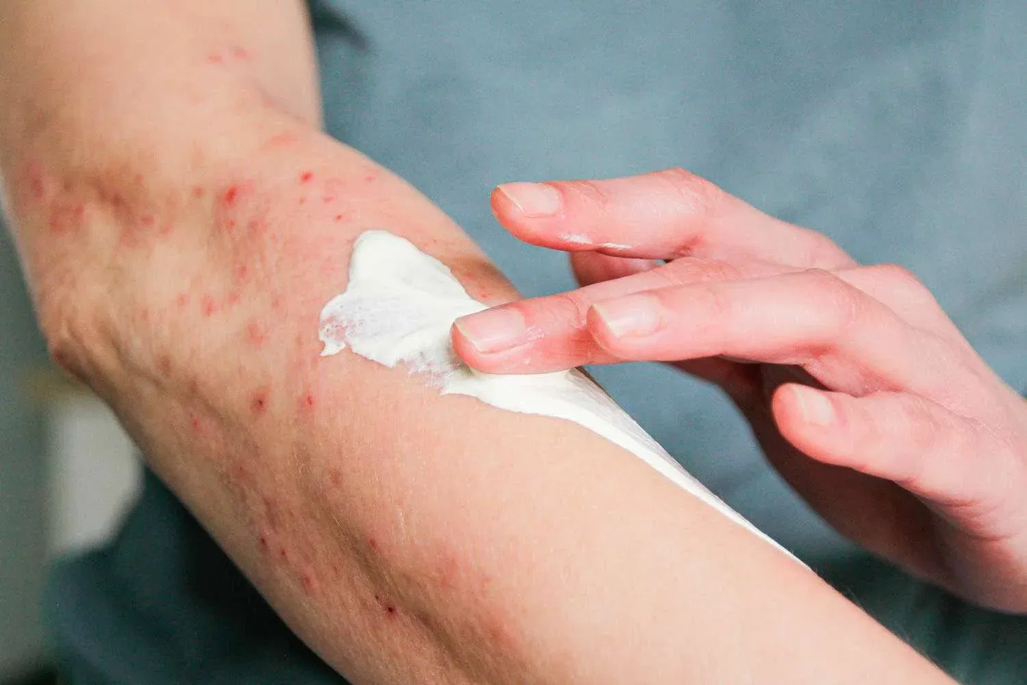 Itchy Bed Bug Bites Relief