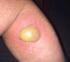 Late Reaction to Wasp Sting