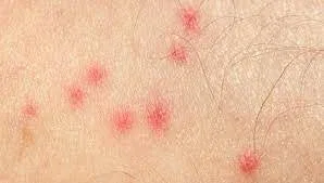 Mosquito Bite Allergy Symptoms