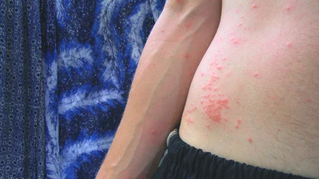 Mosquito Bite Disease Symptoms