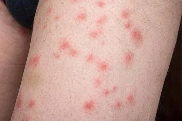 Pictures of Bed Bug Bites