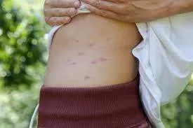 Quick Healing After Bites
