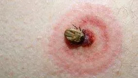 Signs of Tick Bite Infection