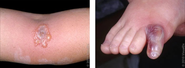 Spider Bite Symptoms and Treatment