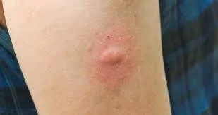 Stress and Bug Bite Flare Ups
