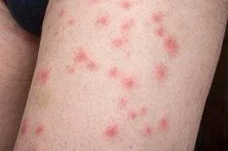 Symptoms of Bed Bug Bites