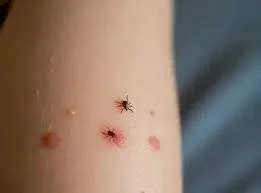 Tick Bite on Kids Treatment