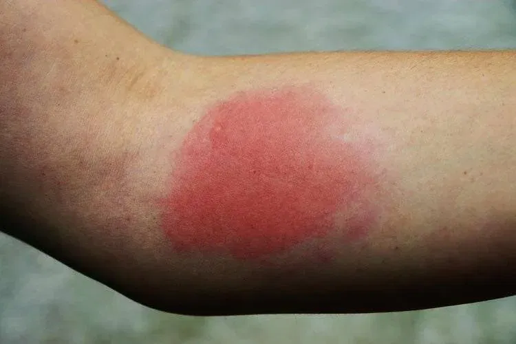 Treating Wasp Sting in Allergic People
