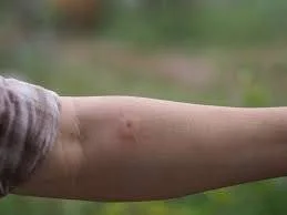 Wasp Sting Complications