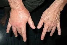 Wasp Sting Swelling Remedies