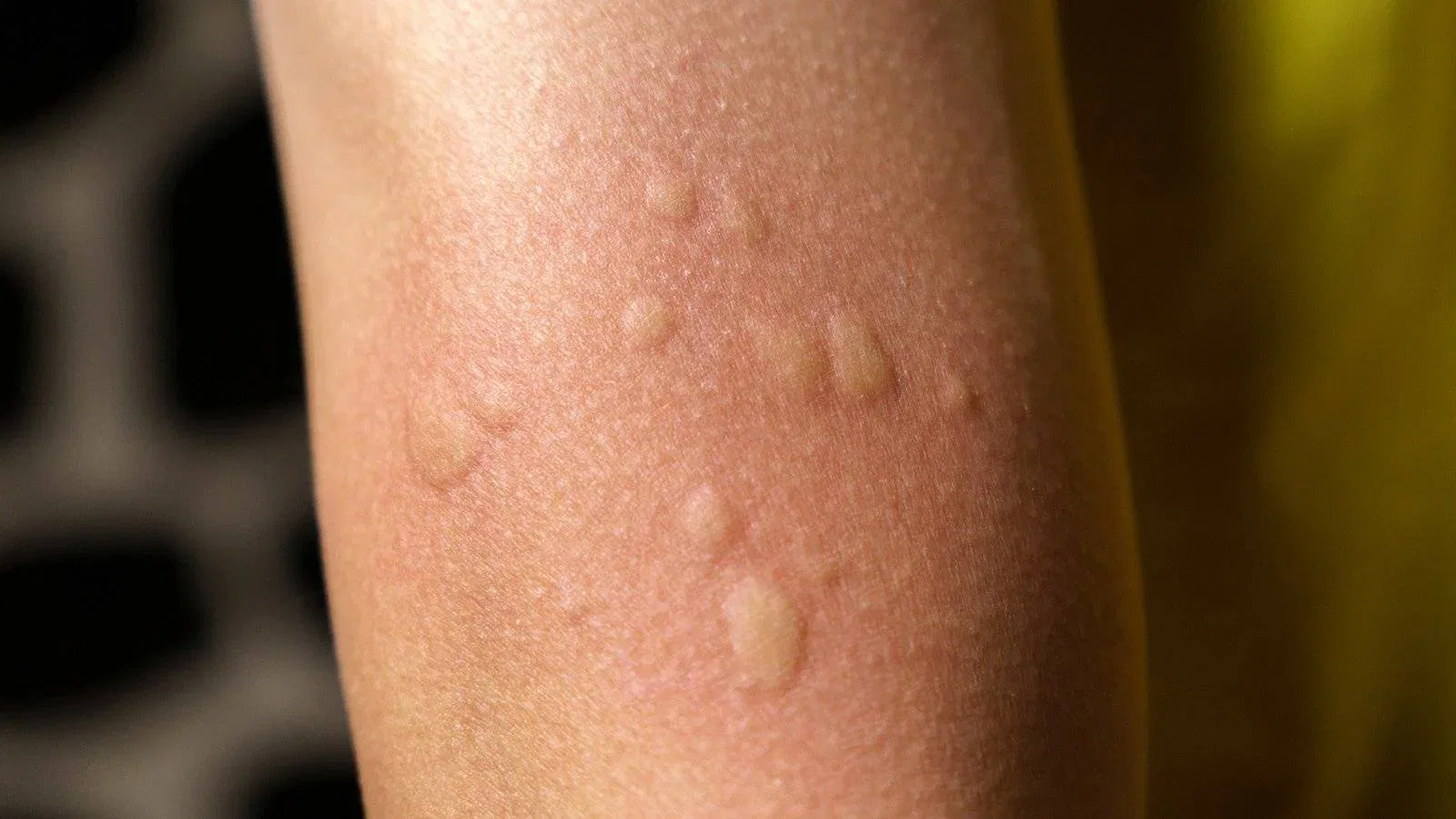 Bed Bug Rash vs. Allergic Reaction